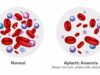 एप्लास्टिक एनीमिया: खून की कमी से आगे की बीमारी, लक्षण, खतरे और आम एनीमिया से फर्क